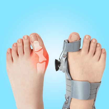 BunionFix™️ - Natural Bunion Corrector