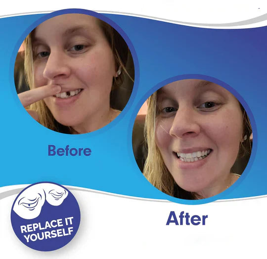 Complete Teeth Veneer Kit Upper Lower Set