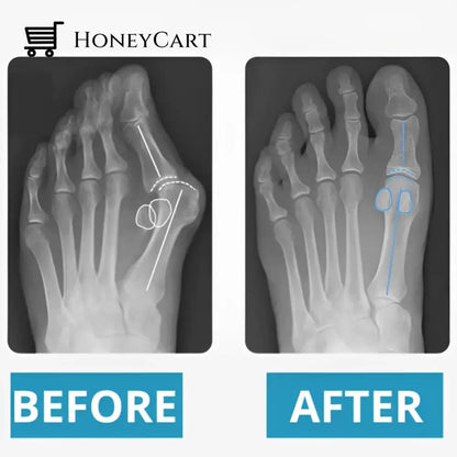 Bunion Corrective Toe Socks